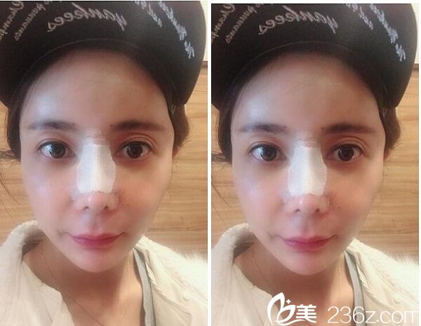 隆鼻后4天恢復(fù)效果 隆鼻后4天恢復(fù)效果