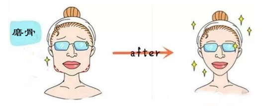 廣州華美磨骨示意圖 廣州華美磨骨示意圖