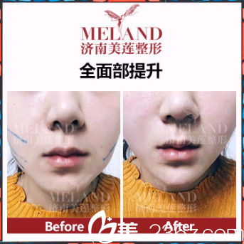 濟(jì)南美蓮(原美萊)整形醫(yī)院面部提升案例分享 濟(jì)南美蓮(原美萊)整形醫(yī)院面部提升案例分享