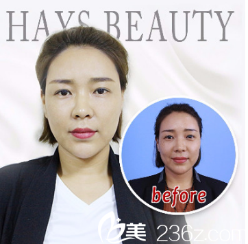 濟(jì)南海峽美容整形醫(yī)院線雕案例分享 濟(jì)南海峽美容整形醫(yī)院線雕案例分享