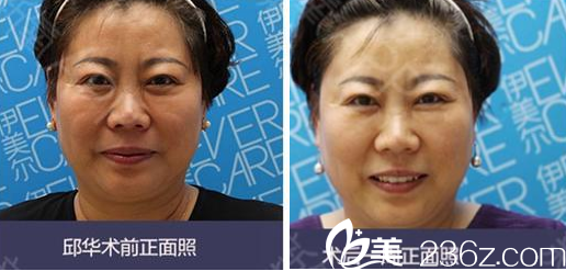 <!--<i data=20240703-sp></i>-->整形美容醫(yī)院提升面部案例分享 <!--<i data=20240703-sp></i>-->整形美容醫(yī)院提升面部案例分享