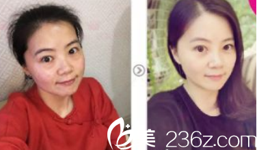 歷下寶琳娜醫(yī)療美容診所埋線提升案例分享 歷下寶琳娜醫(yī)療美容診所埋線提升案例分享