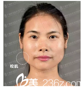 在廣州華美打瘦臉前 在廣州華美打瘦臉前