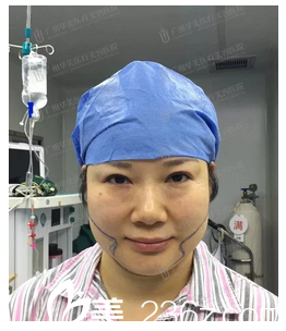 在廣州華美做面部吸脂手術(shù)前 在廣州華美做面部吸脂手術(shù)前