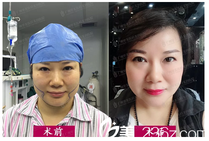 廣州華美面部吸脂前后案例對比 廣州華美面部吸脂前后案例對比