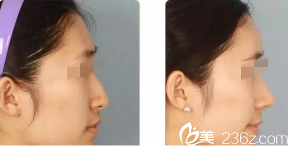 額頭注射玻尿酸前后對(duì)比