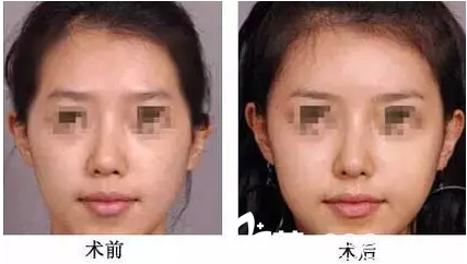 玻尿酸豐額頭效果