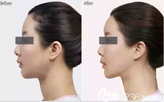 豐額頭真人案例