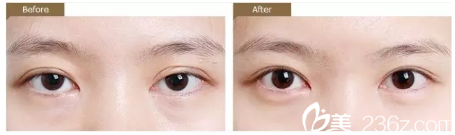 雙眼皮不對(duì)稱修復(fù)案例 雙眼皮不對(duì)稱修復(fù)案例