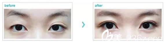 雙眼皮不對稱?太寬?埋線消失?你正在遭受的術(shù)后失敗到南通維多利亞都有修復(fù)案例可提前看效果