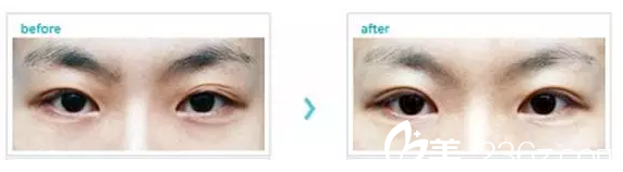 三眼皮修復(fù)案例 三眼皮修復(fù)案例