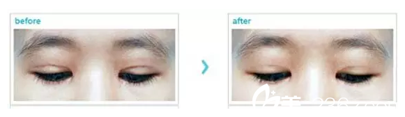 嚴(yán)重疤痕做雙眼皮修復(fù)案例 嚴(yán)重疤痕做雙眼皮修復(fù)案例