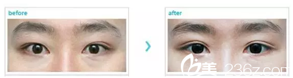 重瞼線較短做修復(fù)案例 重瞼線較短做修復(fù)案例