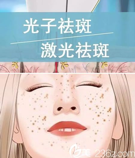 光子祛斑與激光祛斑的區(qū)別