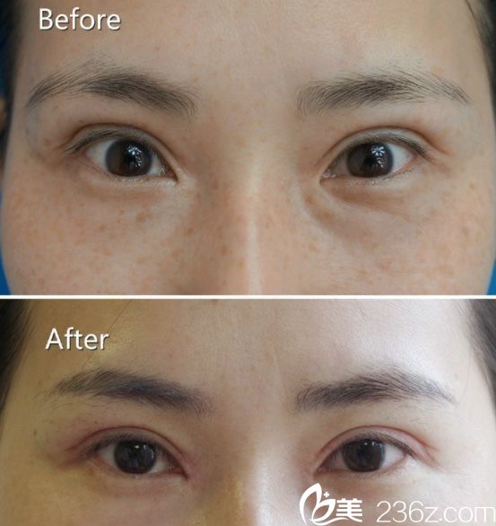 激光祛斑真人案例效果對(duì)比圖