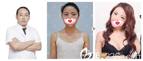 丁慶豐醫(yī)生隆胸案例