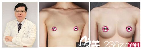 羅盛康隆胸案例