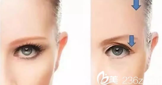 杭州詮昕整形提眉術(shù)案例效果