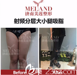 濟(jì)南美蓮（原美萊）醫(yī)療美容醫(yī)院吸脂案例