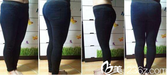 濟(jì)南海峽美容整形醫(yī)院吸脂案例