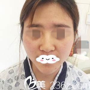 手術(shù)前的我 手術(shù)前的我