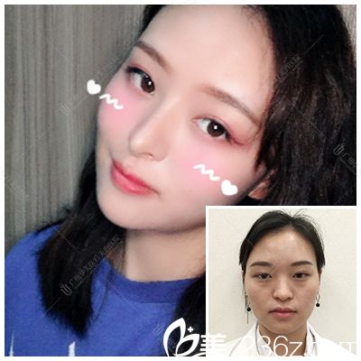 廣州華美郝永生做的自體脂肪面部填充全臉案例