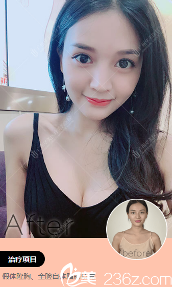 廣州華美郝永生做的自體脂肪填充全臉和隆胸案例