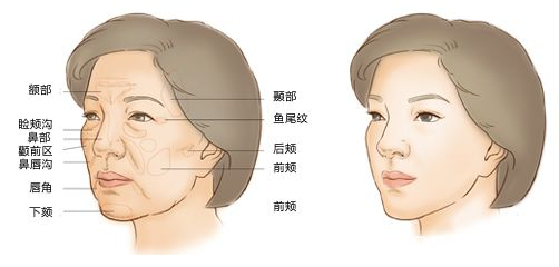 自體脂肪面部填充部位圖