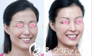 北京壹加壹李惠醫(yī)生面部年輕化案例 北京壹加壹李惠醫(yī)生面部年輕化案例