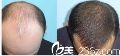 北京壹加壹郝文義自體毛發(fā)移植案例