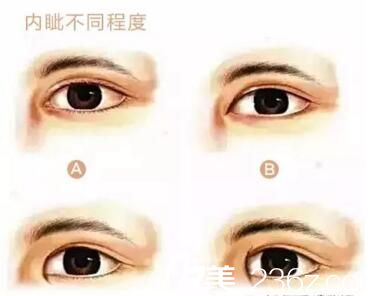 內(nèi)眥贅皮的不同程度 內(nèi)眥贅皮的不同程度