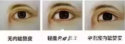 內(nèi)眥贅皮的等級 內(nèi)眥贅皮的等級