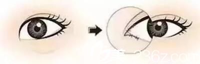 眼角過圓需開眼角 眼角過圓需開眼角
