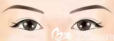 眼間距寬需要開眼角 眼間距寬需要開眼角