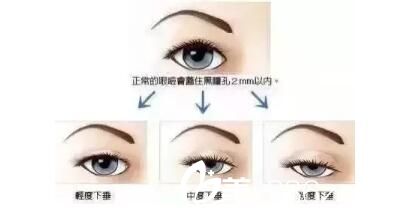 眼瞼下垂需要開眼角 眼瞼下垂需要開眼角