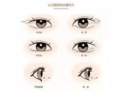 開眼角到底好不好 開眼角到底好不好