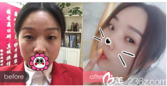 江門華美整形醫(yī)院常海做的雙眼皮案例 江門華美整形醫(yī)院常海做的雙眼皮案例