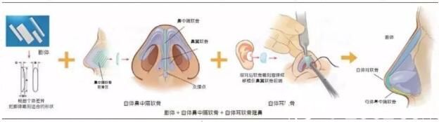 隆鼻假體取出可以放新的假體嗎？