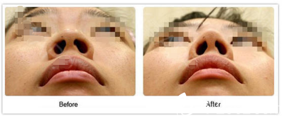 鼻翼縮小前后對(duì)比案例 鼻翼縮小前后對(duì)比案例