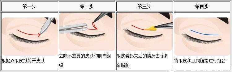 切開雙眼皮手術(shù)原理
