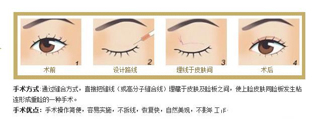 埋線雙眼皮手術(shù)原理