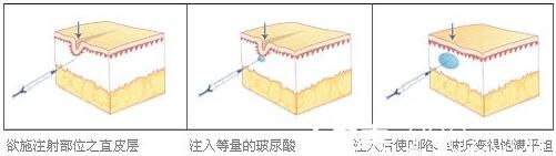 玻尿酸除皺特點