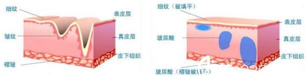 影響玻尿酸除皺價格因素