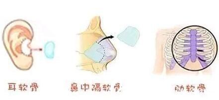 自體軟骨隆鼻常用的三個(gè)軟骨