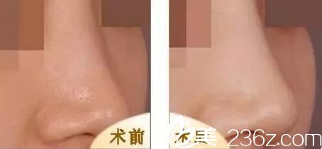 自體軟骨隆鼻真人前后對(duì)比案例