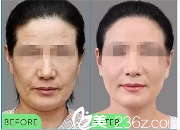 去法令紋前后對(duì)比 去法令紋前后對(duì)比