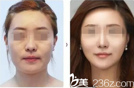 哈爾濱去法令紋真人案例 哈爾濱去法令紋真人案例