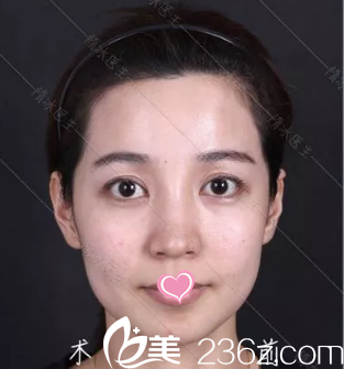 在北京聯(lián)合麗格做弦性面部提升前樣子 在北京聯(lián)合麗格做弦性面部提升前樣子