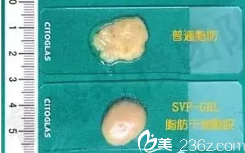 普通脂肪VS脂肪膠質(zhì)地對比