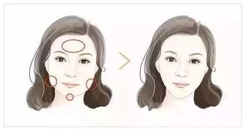 脂肪膠填充恢復(fù)期